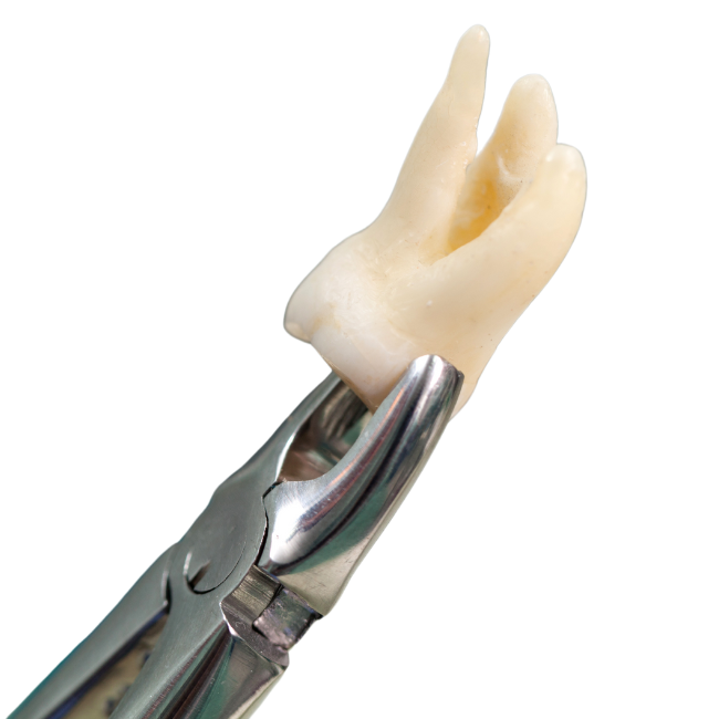 Extracción dental